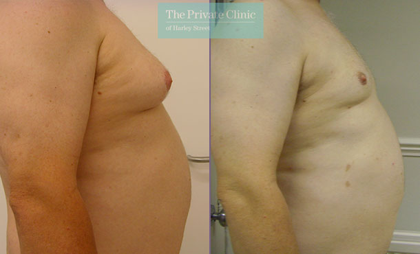 Male Chest Reduction - 001TPC-Side