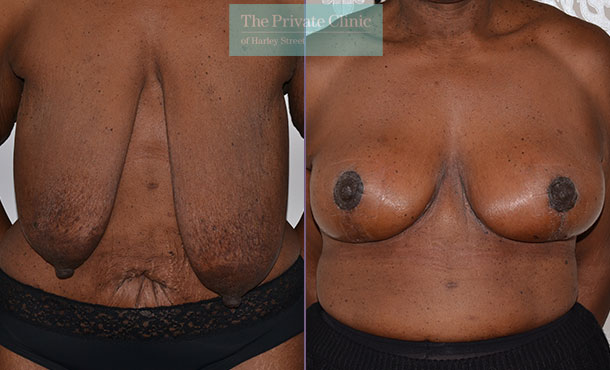 mastopexy surgery breast uplift before after results photos mr adrian richards front 016AR