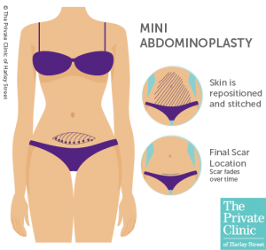 mini tummy tuck abdominoplasty candidate scar