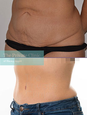 Tummy Tuck Abdominoplasty London By Uk Best Plastic Surgeons Harley Street