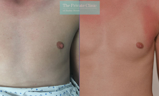 nipple reduction areola before after photo results mr adrian richards 040AR