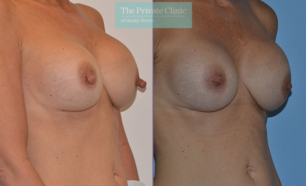 nipple reduction surgery female before after photos london results mr adrian richards 038AR