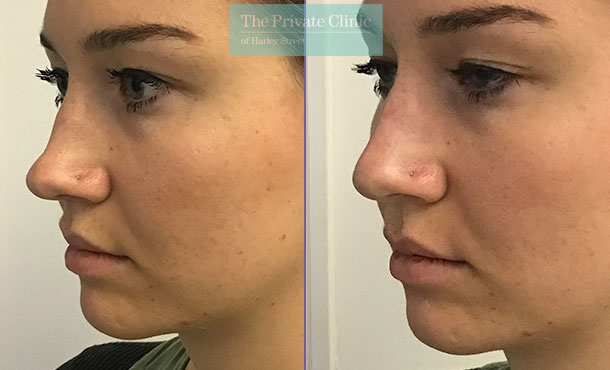 nose fillers non surgical rhinoplasty before after photos results the private clinic 002HHY