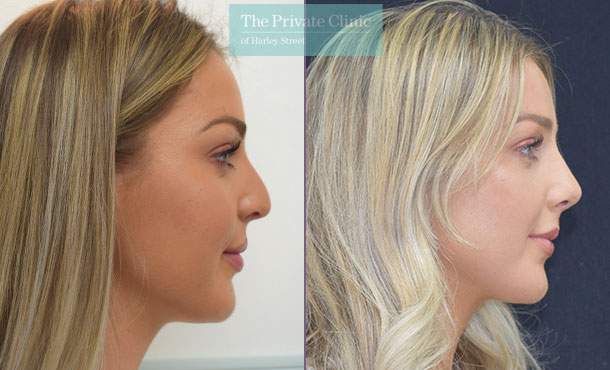 Rhinoplasty Nose Reshaping - 002DR-Side