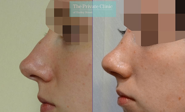 Rhinoplasty Nose Reshaping - 012DF