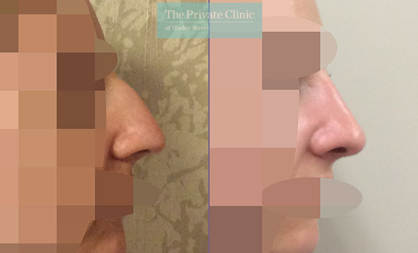 nose reshaping nose job rhinoplasty before after results photos london uk mr davood fallahdar side 013DF