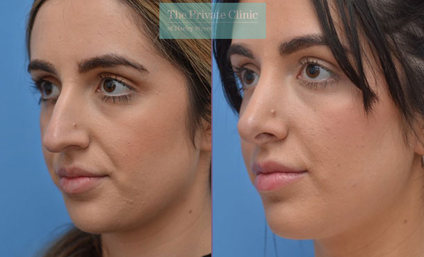 nose reshaping nosejob rhinoplasty before after photos manchester results mr adel fattah angle 004AF