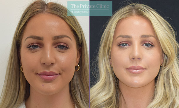 nose reshaping surgery rhinoplasty before after photos bristol results mr dario rochira front 002DR