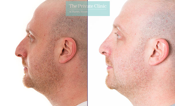 Rhinoplasty Nose Reshaping - 010DF