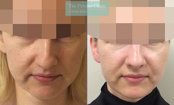 nose reshaping surgery rhinoplasty before after photos london results mr davood fallahdar front 013DF