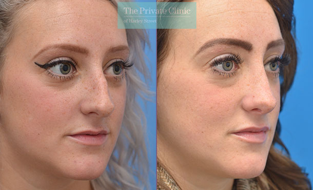 Open Rhinoplasty Nose Reshaping -Side