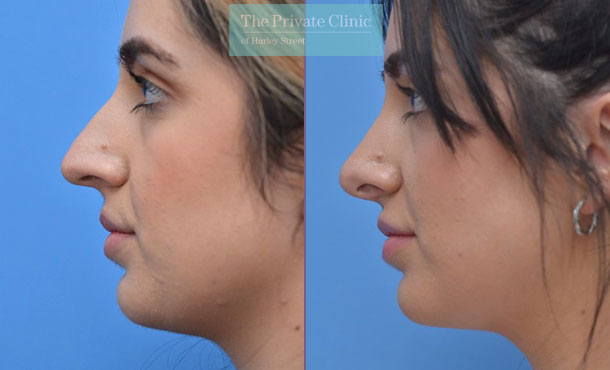 nose reshaping surgery rhinoplasty before after photos manchester results mr adel fattah side 004AF