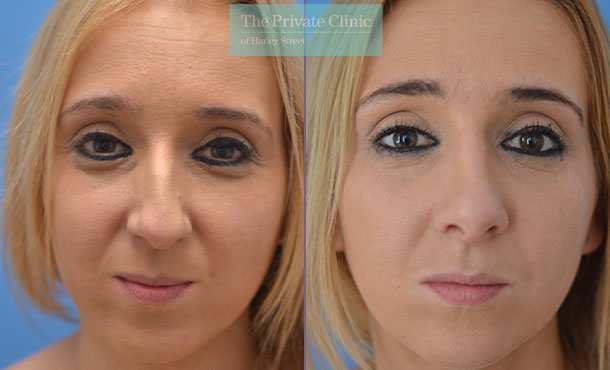 rhinoplasty nose reshaping nosejob before after photos manchester mr adel fattah front 005AF