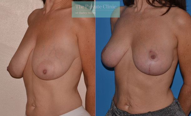 Breast Uplift - 022AR-Side