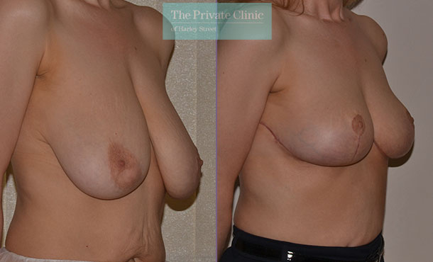 sagging breasts uplift mastopexy surgery before after photos uk mr adrian richards angle 020AR