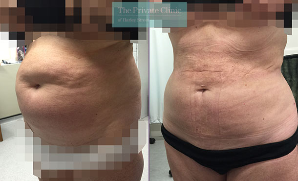 stomach lipo women vaser liposuction before after photos uk the private clinic front 006TPC