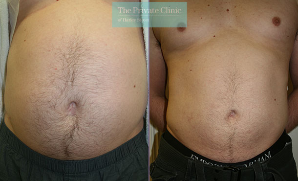 Vaser Liposuction - 004TPC