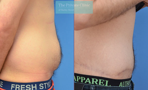 tummy tuck abdominoplasty surgery before after photos manchester results mr adel fattah 006AF