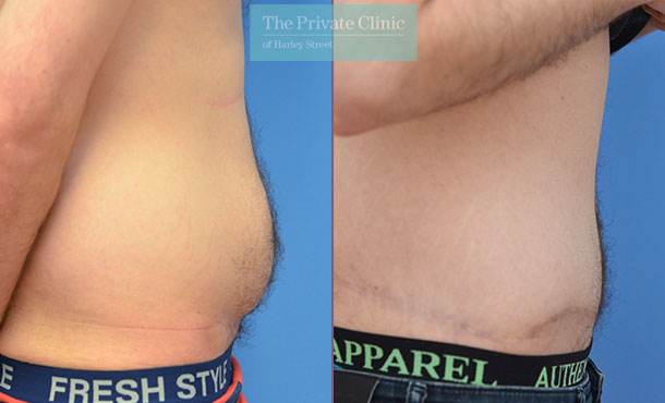 Tummy Tuck / Abdominoplasty - 006AF