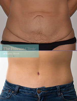 tummy tuck abdominoplasty surgery before after photos results front 057AR