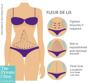 tummy tuck fleur de lis abdominoplasty surgery scars