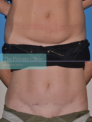 tummy tuck surgery Abdominoplasty before after uk results front 056AR