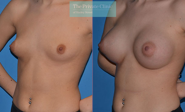 uneven breast correction surgery before after results angle Adrian Richards 049AR