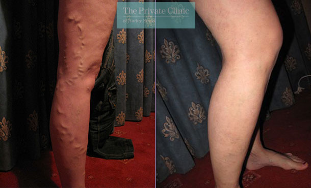 varicose veins removal evla treatment before after photos results uk mr constantinos kyriakides 003CK