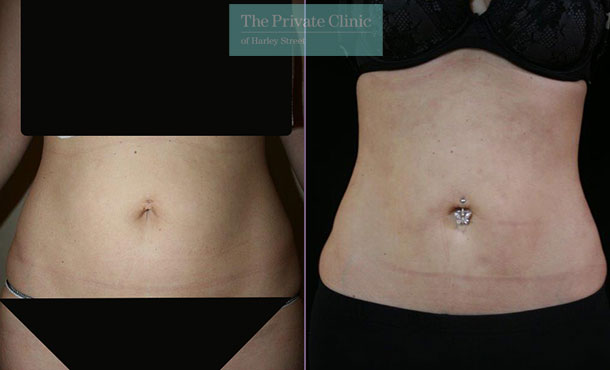 vaser liposuction belly lipo before after results photos london dr dennis wolf 004DW