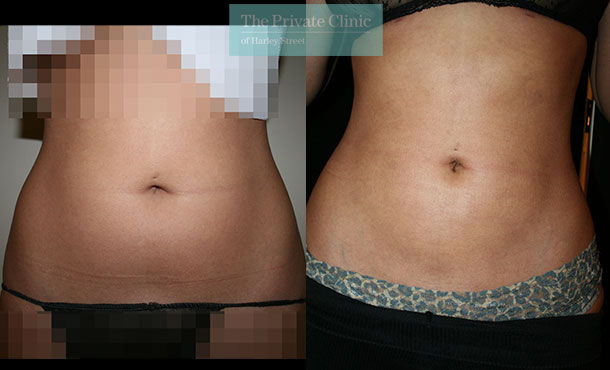vaser liposuction belly lipo female before after results photos dr dennis wolf front 018DW