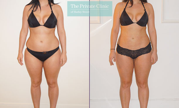 Vaser Liposuction - 003TPC-Front