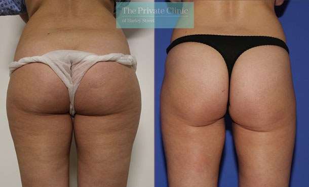 vaser liposuction hips thighs lipo before after photos uk results the private clinic 007TPC