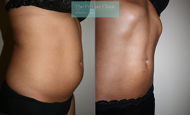 vaser liposuction lipo abdomen before after photos results dr dennis wolf 015DW