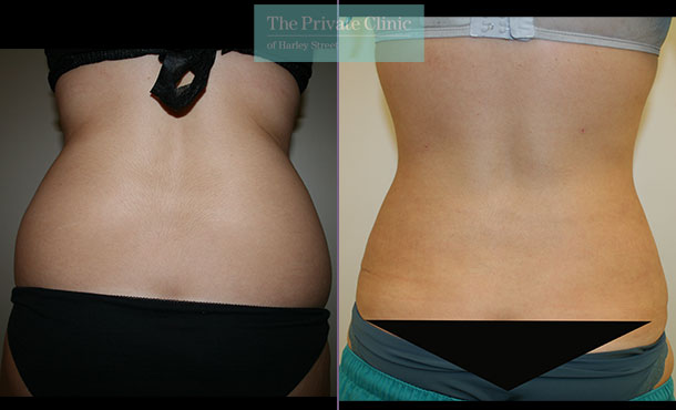 vaser liposuction lipo bra back fat before after results photos dr dennis wolf 007DW
