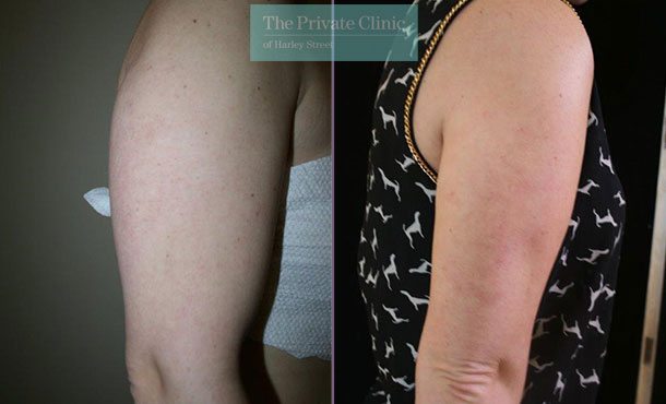 vaser liposuction upper arm fat lipo before after results photos dr dennis wolf 005DW