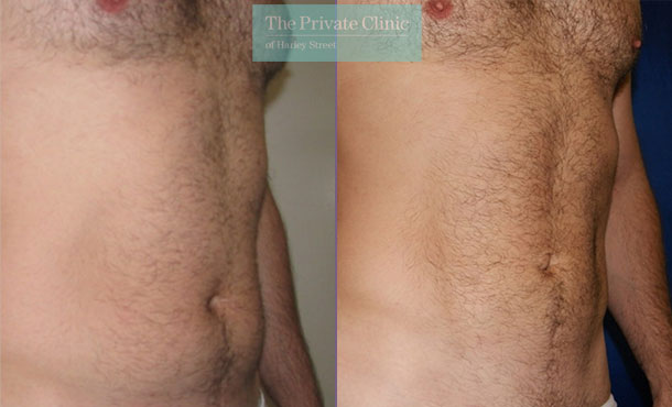 Vaser Liposuction - 011TPC