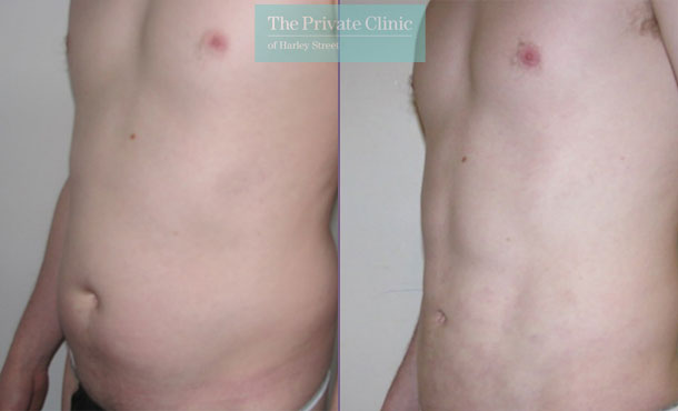 vaser mid def liposuction lipo before after results photos abdomen 012TPC