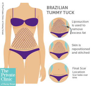 what is brazilian tummy tuck abdominoplasty 300x282 1