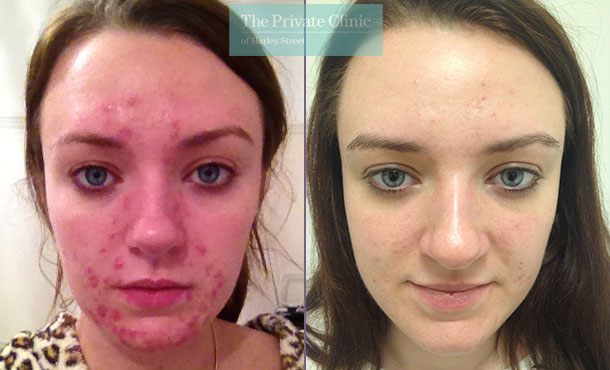 Acne nlite laser before after photo results 016TPC