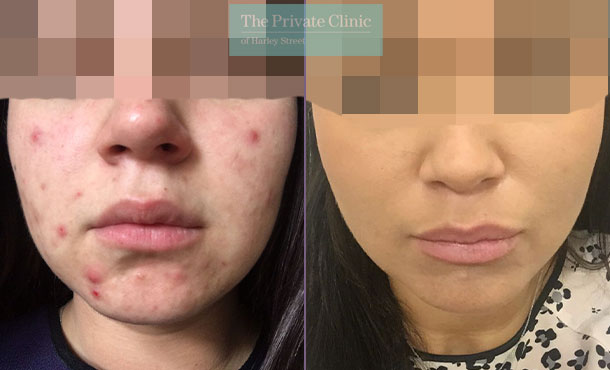 Acne nlite laser treatment near me before after results 021TPC