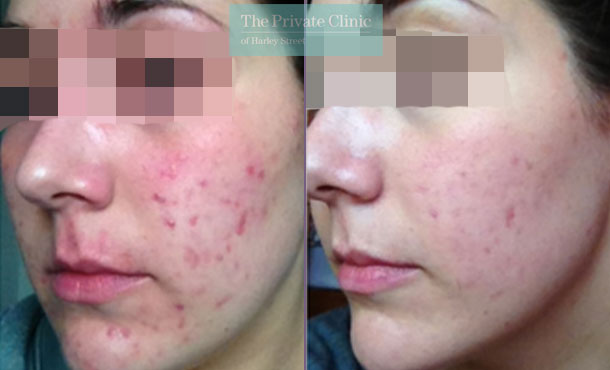 Acne photo before after nlite results 020TPC