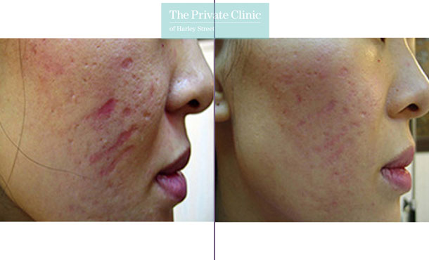 Acne Scars Dermaroller Treatment - 096TPC