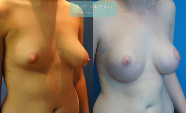 Breast Asymmetry - 058AR-Side