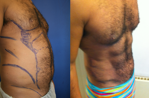 Before and After VASER Hi Def treatment The Private Clinic