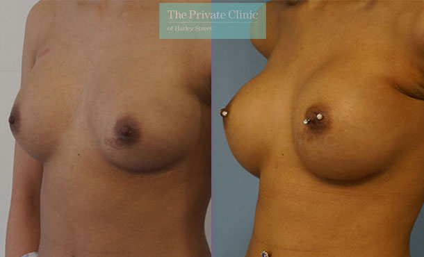 Breast Implant Removal Replacement - 063AR-RR-Side