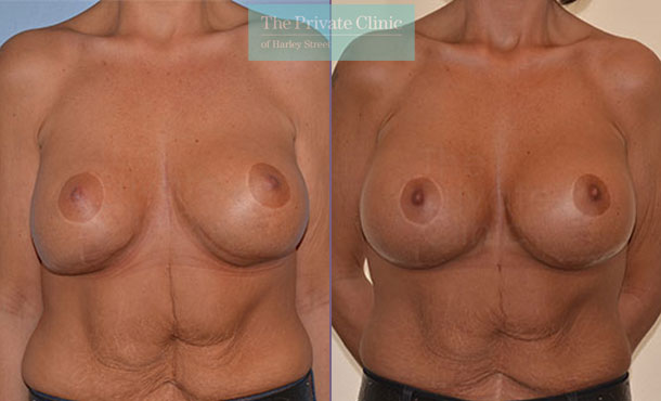Breast Implant Removal Replacement - 064AR-RR-Front