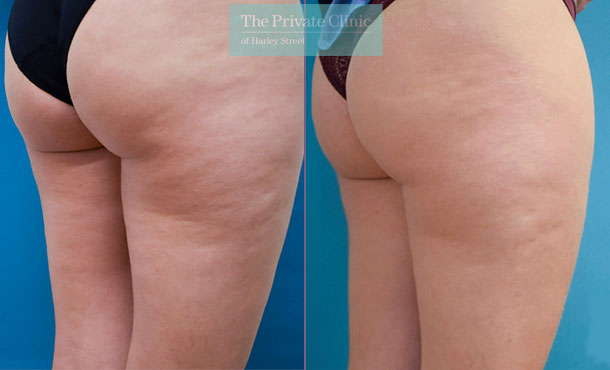 Cellulite Treatments - Before & After Images - The Private Clinic