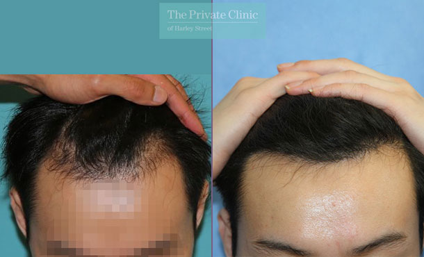 FUE Hair Transplant - 114RR