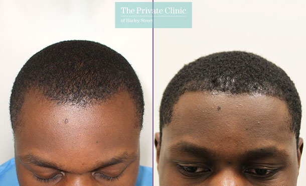 FUE Hair Transplant - 035RR