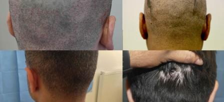 FUE hair transplant recovery web